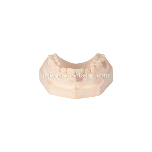Na -customize na layered na korona ng zirconia